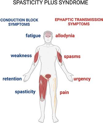 Theoretical and Therapeutic Implications of the Spasticity-Plus Syndrome Model in Multiple Sclerosis